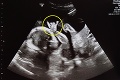 Párik si prvýkrát pozrel svoje dieťatko na ultrazvuku: Všimli si jeho ruku, hneď im bolo všetko jasné!