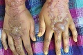 Žena si nechala na dovolenke namaľovať ruky hennou: Kvôli otrasnej reakcii prežíva muky!