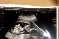 Svetová rarita: Žena znova otehotnela počas toho, ako čakala dvojičky!