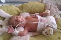 Toľko bolesti len 3 dni po narodení: Malý Vojtíšek prišiel o obe nožičky