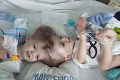 Siamské dvojičky lekári oddeľovali 27 hodín: Neskutočný pohľad na ich hlavičky pred operáciou!