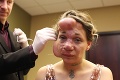 Matku dvoch detí podrobili operácii: Prebrala sa s úplne inou tvárou!
