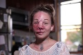Matku dvoch detí podrobili operácii: Prebrala sa s úplne inou tvárou!