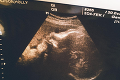 Bývalá Playboy modelka ukázala FOTO z ultrazvuku: Detail na tvári bábätka krásku potešil!