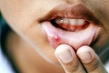 V lete nás trápi oslabená imunita: Ako liečiť infekcie v ústach?