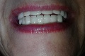 V Maďarsku si dala spraviť zuby za 12 000 eur, výsledok je hororový: Úplne ma zmasakrovali!