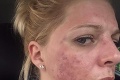 Chemický píling mladú ženu úplne zohavil: Pohľad na jej tvár desí!