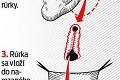 Slovensko sa vo svete blyslo unikátnou operáciou: Z orgánu na tvári vytvorili funkčný penis!