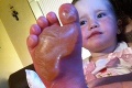Rodičia, v lete dávajte na deti obzvlášť pozor: Pohľad na nohu tohto dievčatka je varovaním!