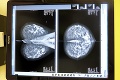 Hádzanárky bojujú proti rakovine: Michalovčanky dostali mamograf za 200 000 €