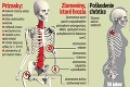 Dnes je svetový deň vážneho ochorenia: Osteoporóza vám vykradne kosti!
