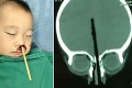 Otrasný pohľad: 7 cm paličky prerazilo chlapcovi cez mozog!