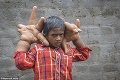 Osemročný chlapček trpí záhadnou chorobou: Jeho gigantické ruky desia okolie!