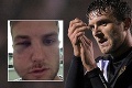 Hráči Port Vale sa pobili, toto je výsledok: Zlomená čelusť, nos a vyhadzov na minútu!