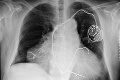 Nezvyčajná situácia: Muž mal dve srdcia, infarkt dostal do oboch