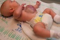 Dievčatko sa narodilo s orgánmi mimo tela, na operáciu čakalo 10 mesiacov