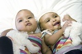 Zrastené dvojičky: Na prežitie operácie mali šancu 1: 10 000 000