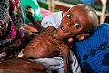Somálsky hladomor má aj šťastný príbeh: Minhaj zomieral hladom, teraz je zdravý