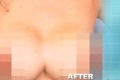 Zhrozená žena: Namiesto krásnych implantátov jej spojili prsia