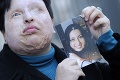 Iránka sa vzdala možnosti kyselinou oslepiť odsúdeného útočníka
