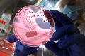 Dvaja pacienti v košickej nemocnici: Nakazili sa nebezpečnou baktériou?!