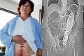 Nešťastná žena: Lekári mi nechali v bruchu 28 cm chirurgickú špachtľu