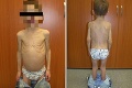 Strašné zverstvo: Rodičia v Česku týrali chlapca (7), vážil len 13,5 kila!