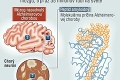 Vedci vynašli liek na Alzheimerovu chorobu!