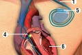 Kardiostimulátor: Viete ako funguje?