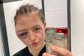 Sexi boxerka skončila po súboji zmenená na nepoznanie: Hlava jej hrozivo napuchla