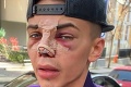 Muž chcel vyzerať ako instagramový filter: Za prerábku tváre vysolil pekný balík! Drsné reakcie ľudí