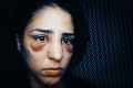 Mladá žena dostala ťažkú alergiu na antidepresíva: Choroba ju zohavila tak, že ju ani nespoznáte!