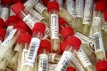 Maďarsko v zovretí koronavírusu: Celkový počet nakazených už prekročil 20 000