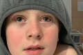 Oliver (11) sa nakazil koronavírusom, rodičov vystrašili nezvyčajné príznaky: Toto chlapca takmer zabilo!