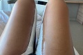 Žena podstúpila liposukciu stehien: Hrôzostrašné zábery! Pohľad na jej nohy je čisté peklo