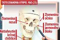 Hráč Spartaka o hororovom zranení: Mama plakala, jazvy mi ostanú