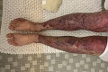 Študent si pri vyprážaní kuraťa spôsobil príšerné popáleniny: Keď sa pozrel od pása dole, krvi by sa v ňom nedorezal