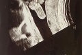Tehotná Lady Mel sa pochválila prvým záberom dieťatka: Roztomilý detail z ultrazvuku