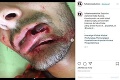 Toto je iba pre silné žalúdky: Detailný záber zranenej tváre Rusova