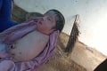 Po pôrode nastalo zhrozenie: Bábätko sa narodilo bez rúk a nôh, vzácna genetická mutácia