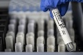 Laboratóriá vykonali za nedeľu 5418 PCR testov: Koľko pribudlo nakazených?