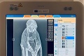 Kuriózny röntgen v levočskej nemocnici! Na oddelení zažili raritu: Takíto pacienti sa len tak nevidia
