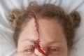 Žena prežila hrozný útok pitbulla: Pozrite sa, ako vyzerá jej tvár dnes!