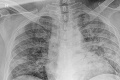 Prečo sú v nemocnici aj očkovaní pacienti? Kulkovský vysvetlil detaily a ukázal hroznú fotku: Toto sú pľúca napadnuté covidom!