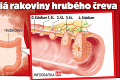 Poisťovne rozbiehajú skríning: Ktorým Slovákom pošlú test na rakovinu hrubého čreva!