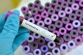 Pandémia koronavírusu naberá v Česku na sile: Brutálny nárast nových nákaz!