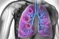 Meky Žbirka († 69) podľahol pneumónii: 5 príčin vzniku zápalu pľúc