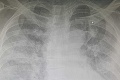 Drsná fotka od lekára Sabaku: Takto vyzerajú pľúca pacienta, ktorý sa na covid liečil ivermektínom!