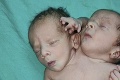 Tehotnej žene povedali, že čaká dvojičky: Pri pôrode prišiel šok!