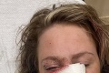 Kaderníčku napadol pes jej klientky: Odhryzol jej nos až na kosť! Jej tvár ostane navždy poznačená